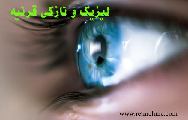 عمل لیزیک و قرنیه نازک