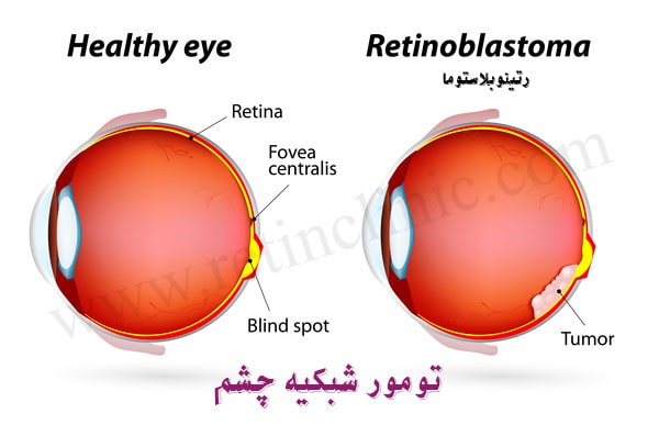 تومور شبکیه