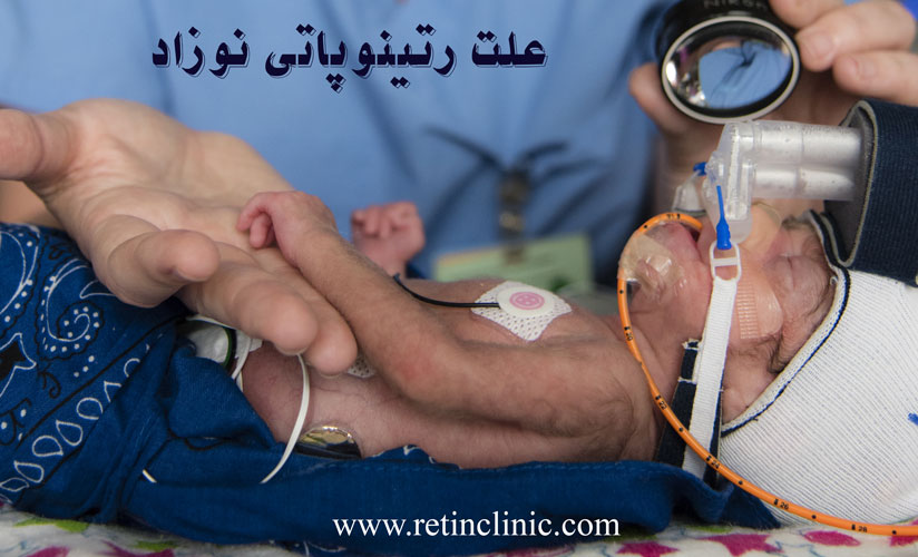 علت رتینوپاتی نوزاد