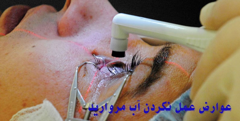 عوارض عمل نکردن آب مروارید