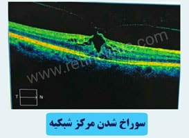 سوراخ شدن شبکیه خانم 67 ساله
