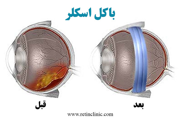  درمان پارگی شبکیه