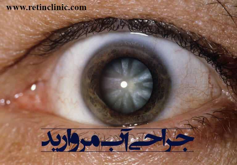 جراحی آب مروارید