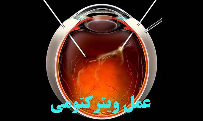 عمل ویترکتومی