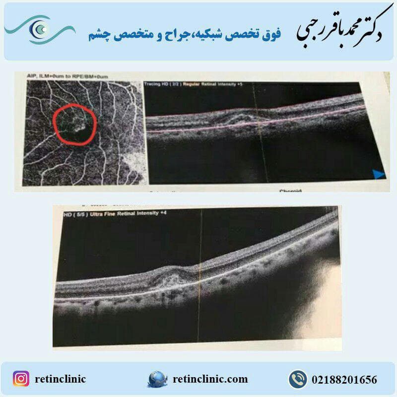 كلافه عروقی اضافه در مركز شبكيه