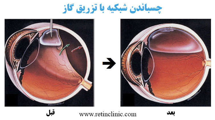  درمان پارگی شبکیه