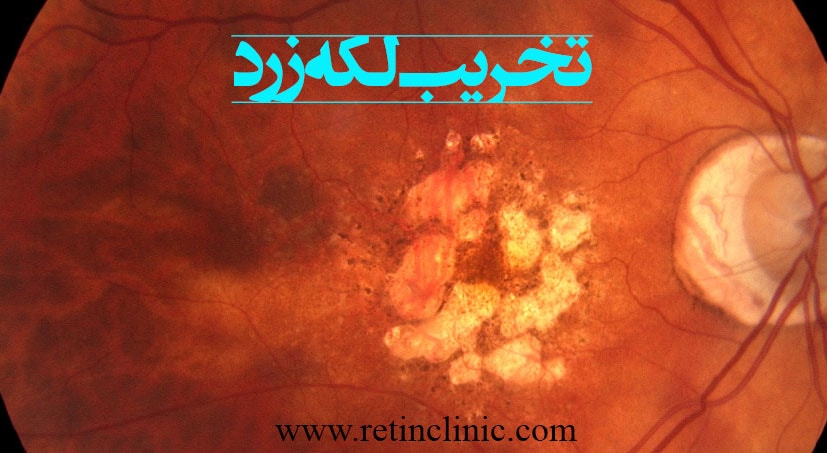 تخریب لکه زرد