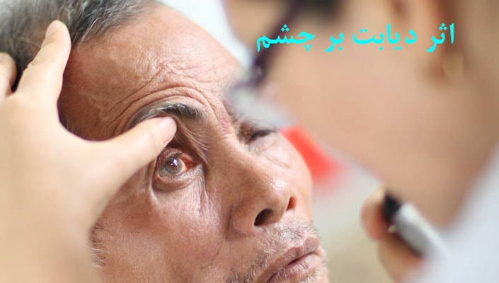 اثر دیابت بر چشم