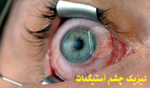عمل لیزیک چشم آستیگمات