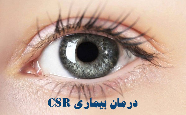درمان بیماری csr