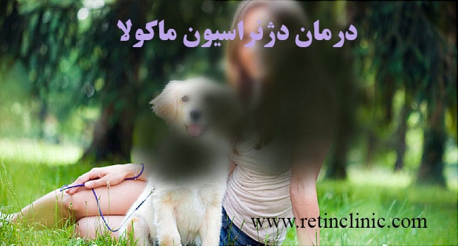 درمان دژنراسیون ماکولا