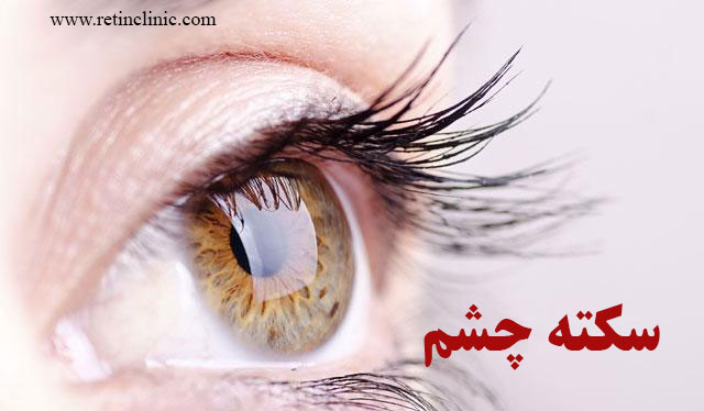 سکته شبکیه چشم