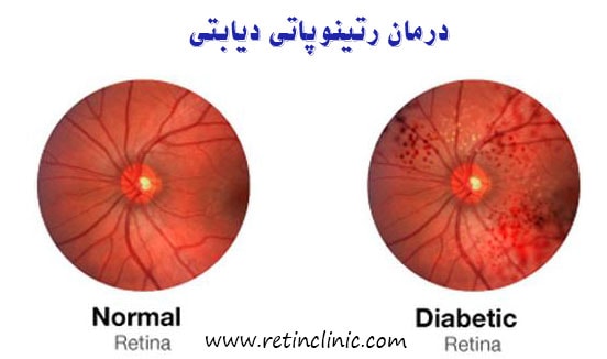 درمان رتینوپاتی دیابتی