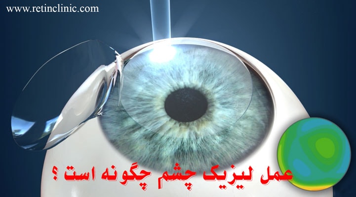 عمل لیزیک چشم چگونه است ؟