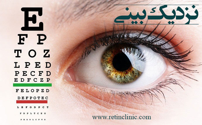 نزدیک بینی