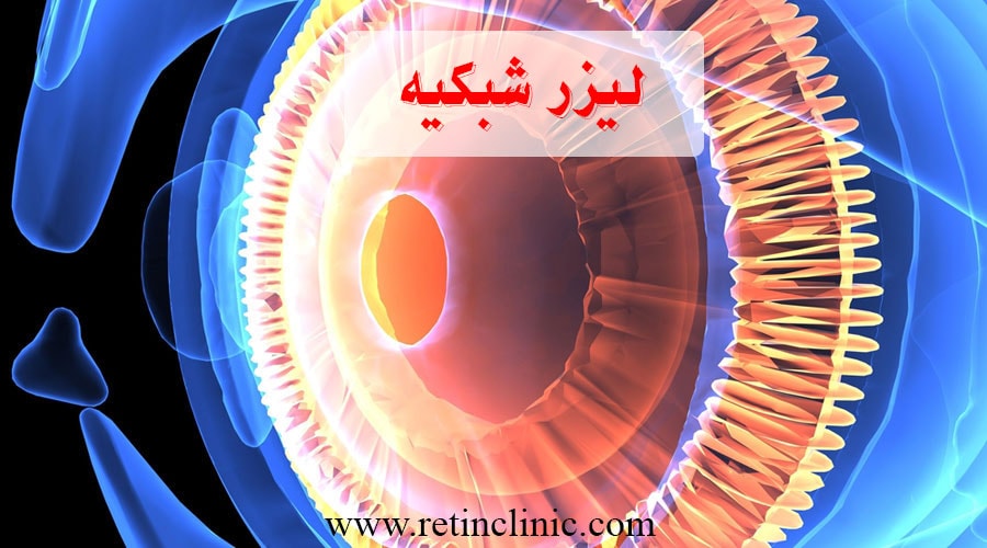 لیزر شبکیه