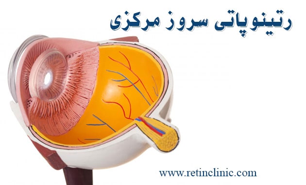 رتینوپاتی سروز مرکزی