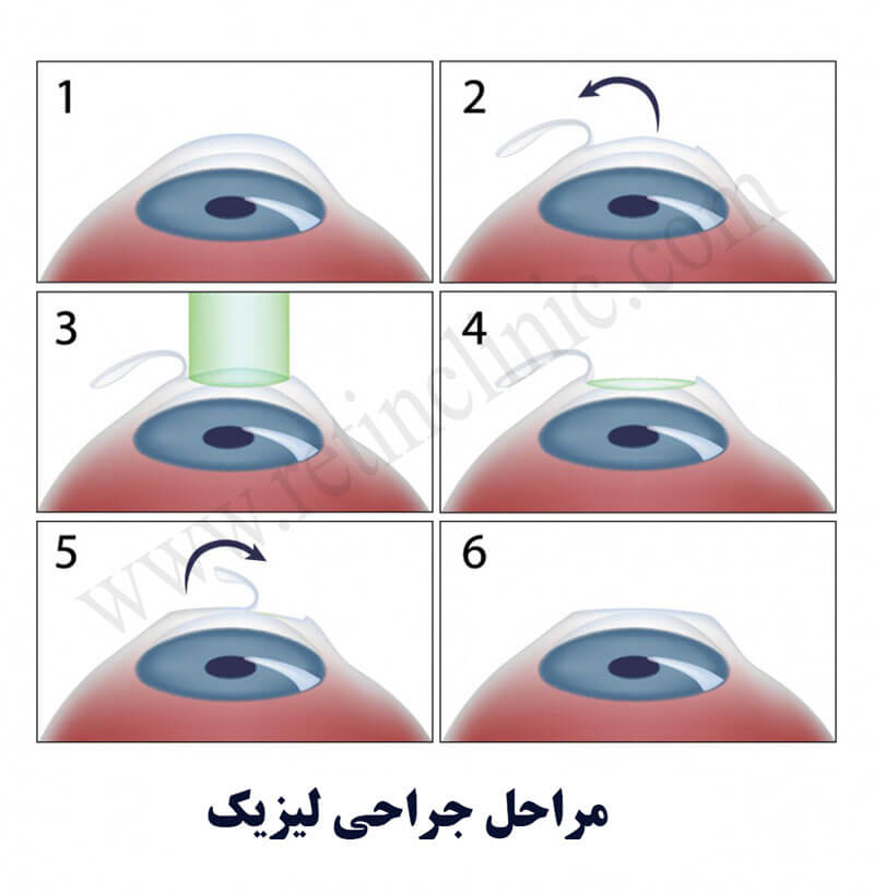 جراحی لیزیک