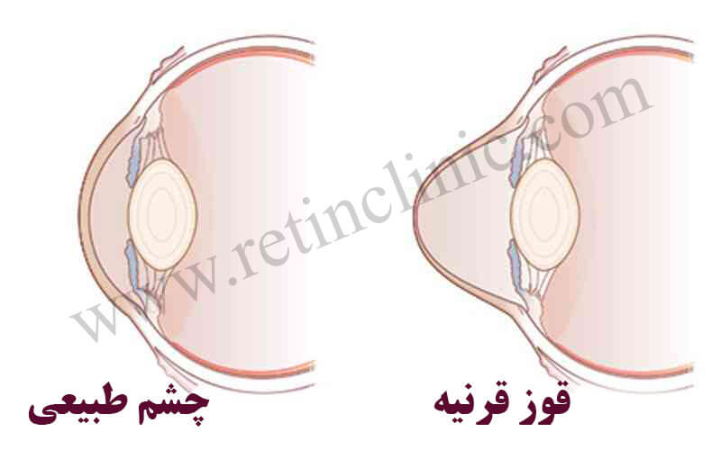 قوز قرنیه